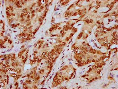IHC image of the antibody diluted at 1:20 and staining in paraffin-embedded human liver cancer performed on a Leica BondTM system. After dewaxing and hydration, antigen retrieval was mediated by high pressure in a citrate buffer (pH 6.0). Section was blocked with 10% normal goat serum 30min at RT. Then primary antibody (1% BSA) was incubated at 4°C overnight. The primary is detected by a biotinylated secondary antibody and visualized using an HRP conjugated SP system.Rabbit anti-Human HIST1H4A Polyclonal Antibody
