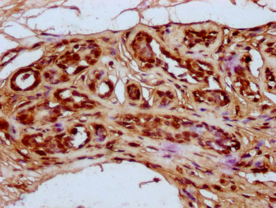 IHC image of HIST1H4A (Ab-79) Antibody diluted at 1:20 and staining in paraffin-embedded human breast cancer performed on a Leica BondTM system. After dewaxing and hydration, antigen retrieval was mediated by high pressure in a citrate buffer (pH 6.0). Section was blocked with 10% normal goat serum 30min at RT. Then primary antibody (1% BSA) was incubated at 4°C overnight. The primary is detected by a biotinylated secondary antibody and visualized using an HRP conjugated SP system.Rabbit anti-Human HIST1H4A Polyclonal Antibody