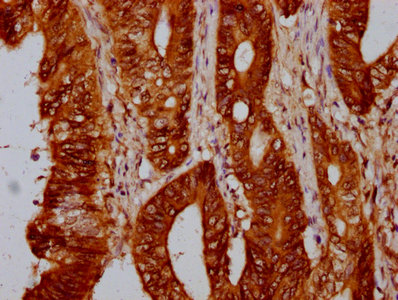 IHC image of the antibody diluted at 1:10 and staining in paraffin-embedded human colon cancer performed on a Leica BondTM system. After dewaxing and hydration, antigen retrieval was mediated by high pressure in a citrate buffer (pH 6.0). Section was blocked with 10% normal goat serum 30min at RT. Then primary antibody (1% BSA) was incubated at 4°C overnight. The primary is detected by a biotinylated secondary antibody and visualized using an HRP conjugated SP system.Rabbit anti-Human HIST1H4A Polyclonal Antibody