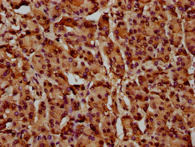 IHC image of HIST1H4A (Ab-88) Antibody diluted at 1:10 and staining in paraffin-embedded human pancreatic cancer performed on a Leica BondTM system. After dewaxing and hydration, antigen retrieval was mediated by high pressure in a citrate buffer (pH 6.0). Section was blocked with 10% normal goat serum 30min at RT. Then primary antibody (1% BSA) was incubated at 4°C overnight. The primary is detected by a biotinylated secondary antibody and visualized using an HRP conjugated SP system.Rabbit anti-Human HIST1H4A Polyclonal Antibody