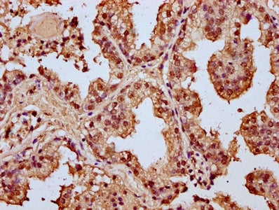 IHC image of HIST1H4A (Ab-91) Antibody diluted at 1:20 and staining in paraffin-embedded human prostate cancer performed on a Leica BondTM system. After dewaxing and hydration, antigen retrieval was mediated by high pressure in a citrate buffer (pH 6.0). Section was blocked with 10% normal goat serum 30min at RT. Then primary antibody (1% BSA) was incubated at 4°C overnight. The primary is detected by a biotinylated secondary antibody and visualized using an HRP conjugated SP system.Rabbit anti-Human HIST1H4A Polyclonal Antibody