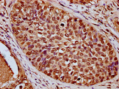 IHC image of HIST1H4A (Ab-91) Antibody diluted at 1:20 and staining in paraffin-embedded human cervical cancer performed on a Leica BondTM system. After dewaxing and hydration, antigen retrieval was mediated by high pressure in a citrate buffer (pH 6.0). Section was blocked with 10% normal goat serum 30min at RT. Then primary antibody (1% BSA) was incubated at 4°C overnight. The primary is detected by a biotinylated secondary antibody and visualized using an HRP conjugated SP system.Rabbit anti-Human HIST1H4A Polyclonal Antibody