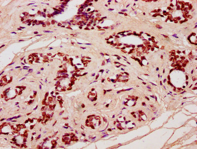 IHC image of the antibody diluted at 1:20 and staining in paraffin-embedded human breast cancer performed on a Leica BondTM system. After dewaxing and hydration, antigen retrieval was mediated by high pressure in a citrate buffer (pH 6.0). Section was blocked with 10% normal goat serum 30min at RT. Then primary antibody (1% BSA) was incubated at 4°C overnight. The primary is detected by a biotinylated secondary antibody and visualized using an HRP conjugated SP system.Rabbit anti-Human HIST1H4A Polyclonal Antibody