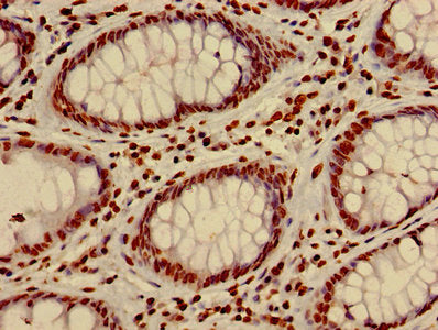 Immunohistochemistry of paraffin-embedded human colon cancer using HIST1H4A (Ab-8) Antibody at dilution of 1:100Rabbit anti-Human HIST1H4A Polyclonal Antibody