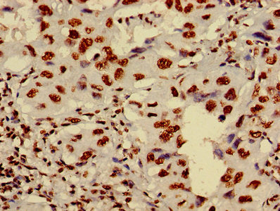 Immunohistochemistry of paraffin-embedded human lung cancer using HIST1H4A (Ab-8) Antibody at dilution of 1:100Rabbit anti-Human HIST1H4A Polyclonal Antibody