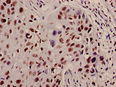 Immunohistochemistry of paraffin-embedded human cervical cancer using HIST1H4A (Ab-12) Antibody at dilution of 1:100Rabbit anti-Human HIST1H4A Polyclonal Antibody
