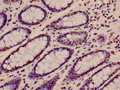 Immunohistochemistry of paraffin-embedded human colon cancer using HIST1H4A (Ab-12) Antibody at dilution of 1:100Rabbit anti-Human HIST1H4A Polyclonal Antibody