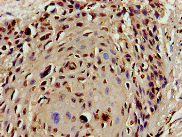 Immunohistochemistry of paraffin-embedded human cervical cancer using the antibody at dilution of 1:100Rabbit anti-Human HIST1H4A Polyclonal Antibody