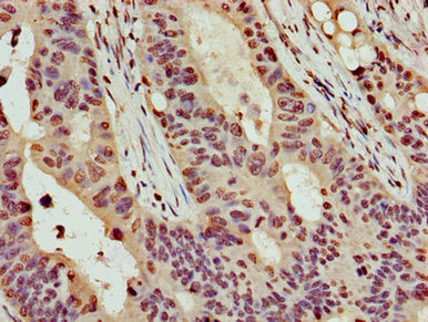Immunohistochemistry of paraffin-embedded human colon cancer using HIST1H4A (Ab-16) Antibody at dilution of 1:100Rabbit anti-Human HIST1H4A Polyclonal Antibody