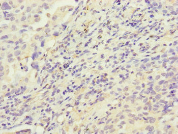 Immunohistochemistry of paraffin-embedded human lung cancer using HK3 Antibody at dilution of 1:100Rabbit anti-Human HK3 Polyclonal Antibody