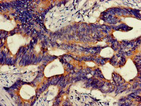 Immunohistochemistry of paraffin-embedded human colon cancer using HMBS Antibody at dilution of 1:100Rabbit anti-Human HMBS Polyclonal Antibody