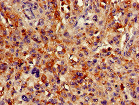 Immunohistochemistry of paraffin-embedded human melanoma using HMBS Antibody at dilution of 1:100Rabbit anti-Human HMBS Polyclonal Antibody