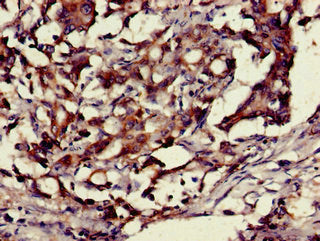 Immunohistochemistry of paraffin-embedded human gastric cancer using HMGB1 Antibody at dilution of 1:100Rabbit anti-Human HMGB1 Polyclonal Antibody