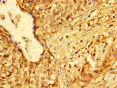 IHC image of HMGB3 Antibody diluted at 1:300 and staining in paraffin-embedded human cervical cancer performed on a Leica BondTM system. After dewaxing and hydration, antigen retrieval was mediated by high pressure in a citrate buffer (pH 6.0). Section was blocked with 10% normal goat serum 30min at RT. Then primary antibody (1% BSA) was incubated at 4°C overnight. The primary is detected by a biotinylated secondary antibody and visualized using an HRP conjugated SP system.Rabbit anti-Human HMGB3 Polyclonal Antibody