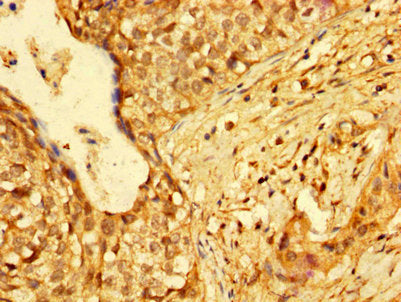 IHC image of HMGB3 Antibody diluted at 1:300 and staining in paraffin-embedded human cervical cancer performed on a Leica BondTM system. After dewaxing and hydration, antigen retrieval was mediated by high pressure in a citrate buffer (pH 6.0). Section was blocked with 10% normal goat serum 30min at RT. Then primary antibody (1% BSA) was incubated at 4°C overnight. The primary is detected by a biotinylated secondary antibody and visualized using an HRP conjugated SP system.Rabbit anti-Human HMGB3 Polyclonal Antibody