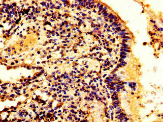 IHC image of HMGB3 Antibody diluted at 1:300 and staining in paraffin-embedded human lung cancer performed on a Leica BondTM system. After dewaxing and hydration, antigen retrieval was mediated by high pressure in a citrate buffer (pH 6.0). Section was blocked with 10% normal goat serum 30min at RT. Then primary antibody (1% BSA) was incubated at 4°C overnight. The primary is detected by a biotinylated secondary antibody and visualized using an HRP conjugated SP system.Rabbit anti-Human HMGB3 Polyclonal Antibody