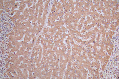 IHC image of HMGCR Antibody diluted at 1:150 and staining in paraffin-embedded human liver cancer  performed on a Leica BondTM system. After dewaxing and hydration, antigen retrieval was mediated by high pressure in a citrate buffer (pH 6.0). Section was blocked with 10% normal goat serum 30min at RT. Then primary antibody (1% BSA) was incubated at 4°C overnight. The primary is detected by a biotinylated secondary antibody and visualized using an HRP conjugated SP system.Rabbit anti-Human HMGCR Polyclonal Antibody