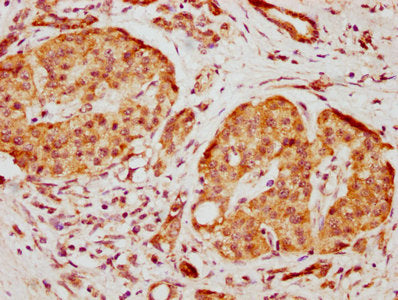 IHC image of HMGCS1 Antibody diluted at 1:500 and staining in paraffin-embedded human pancreatic cancer performed on a Leica BondTM system. After dewaxing and hydration, antigen retrieval was mediated by high pressure in a citrate buffer (pH 6.0). Section was blocked with 10% normal goat serum 30min at RT. Then primary antibody (1% BSA) was incubated at 4°C overnight. The primary is detected by a biotinylated secondary antibody and visualized using an HRP conjugated SP system.Rabbit anti-Human HMGCS1 Polyclonal Antibody