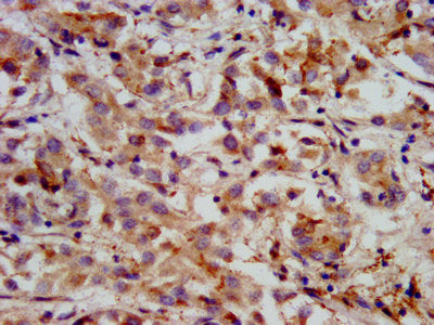 IHC image of HMGCS2 Antibody diluted at 1:400 and staining in paraffin-embedded human liver cancer performed on a Leica BondTM system. After dewaxing and hydration, antigen retrieval was mediated by high pressure in a citrate buffer (pH 6.0). Section was blocked with 10% normal goat serum 30min at RT. Then primary antibody (1% BSA) was incubated at 4°C overnight. The primary is detected by a biotinylated secondary antibody and visualized using an HRP conjugated SP system.Rabbit anti-Human HMGCS2 Polyclonal Antibody