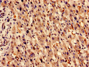Immunocytochemistry analysis of human liver cancer using the antibody at dilution of 1:100Rabbit anti-Human HMOX1 Polyclonal Antibody