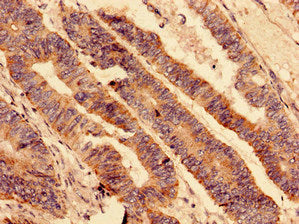Immunocytochemistry analysis of human colon cancer using HMOX1 Antibody at dilution of 1:100Rabbit anti-Human HMOX1 Polyclonal Antibody