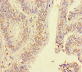 Immunohistochemistry of paraffin-embedded human colon cancer using the antibody at dilution of 1:100Rabbit anti-Human HNRNPA2B1 Polyclonal Antibody
