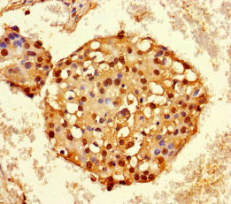 Immunohistochemistry of paraffin-embedded human breast cancer using HNRNPA2B1 Antibody at dilution of 1:100Rabbit anti-Human HNRNPA2B1 Polyclonal Antibody