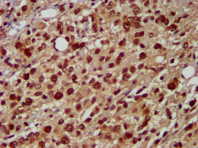 IHC image of HNRNPAB Antibody diluted at 1:500 and staining in paraffin-embedded human glioma performed on a Leica BondTM system. After dewaxing and hydration, antigen retrieval was mediated by high pressure in a citrate buffer (pH 6.0). Section was blocked with 10% normal goat serum 30min at RT. Then primary antibody (1% BSA) was incubated at 4°C overnight. The primary is detected by a biotinylated secondary antibody and visualized using an HRP conjugated SP system.Rabbit anti-Human HNRNPAB Polyclonal Antibody