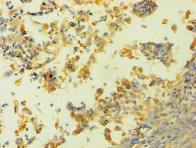 Immunohistochemistry of paraffin-embedded human cervical cancer using HNRNPH1 Antibody at dilution of 1:100Rabbit anti-Human HNRNPH1 Polyclonal Antibody