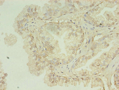 Immunohistochemistry of paraffin-embedded human prostate cancer using HNRNPL Antibody at dilution of 1:100Rabbit anti-Human HNRNPL Polyclonal Antibody