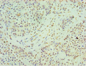 Immunohistochemistry of paraffin-embedded human breast cancer using HNRNPM Antibody at dilution of 1:100Rabbit anti-Human HNRNPM Polyclonal Antibody
