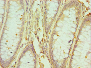 Immunohistochemistry of paraffin-embedded human colon cancer using HNRNPM Antibody at dilution of 1:100Rabbit anti-Human HNRNPM Polyclonal Antibody