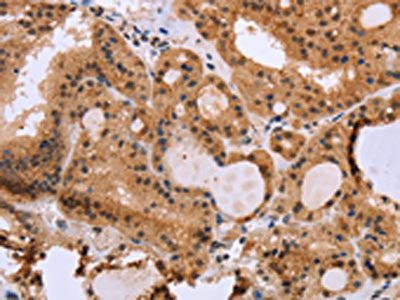 The image on the left is immunohistochemistry of paraffin-embedded Human thyroid cancer tissue using EPDR1 Antibody(EPDR1 Antibody) at dilution 1/40, on the right is treated with fusion protein. (Original magnification: ×200)Rabbit anti-Human EPDR1 Polyclonal Antibody