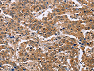The image on the left is immunohistochemistry of paraffin-embedded Human liver cancer tissue using the antibody Antibody) at dilution 1/40, on the right is treated with fusion protein. (Original magnification: ×200)Rabbit anti-Human EPDR1 Polyclonal Antibody