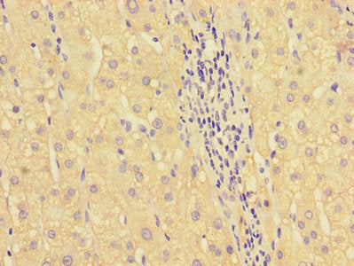 Immunohistochemistry of paraffin-embedded human liver cancer using the antibody at dilution of 1:100Rabbit anti-Human HOXA2 Polyclonal Antibody
