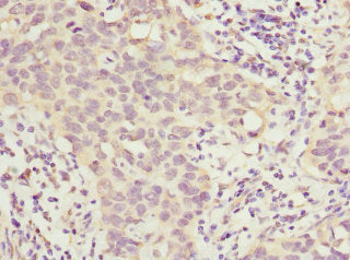 Immunohistochemistry of paraffin-embedded human bladder cancer using HOXD10 Antibody at dilution of 1:100Rabbit anti-Human HOXD10 Polyclonal Antibody