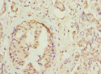 Immunohistochemistry of paraffin-embedded human pancreatic cancer using HOXD10 Antibody at dilution of 1:100Rabbit anti-Human HOXD10 Polyclonal Antibody
