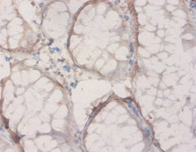 Immunohistochemistry of paraffin-embedded human colon cancer using HPD Antibody at dilution of 1:20Rabbit anti-Human HPD Polyclonal Antibody