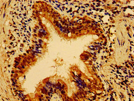 Immunohistochemistry of paraffin-embedded human lung cancer using HS2ST1 Antibody at dilution of 1:100Rabbit anti-Human HS2ST1 Polyclonal Antibody