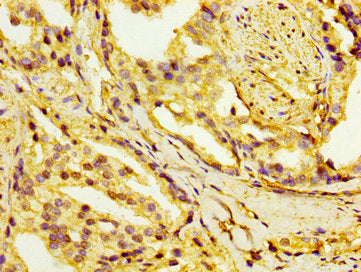 IHC image of the antibody diluted at 1:100 and staining in paraffin-embedded human prostate cancer performed on a Leica BondTM system. After dewaxing and hydration, antigen retrieval was mediated by high pressure in a citrate buffer (pH 6.0). Section was blocked with 10% normal goat serum 30min at RT. Then primary antibody (1% BSA) was incubated at 4°C overnight. The primary is detected by a biotinylated secondary antibody and visualized using an HRP conjugated SP system.Rabbit anti-Human HSD17B1 Polyclonal Antibody