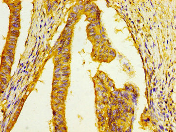 IHC image of HSD17B1 Antibody diluted at 1:100 and staining in paraffin-embedded human colon cancer performed on a Leica BondTM system. After dewaxing and hydration, antigen retrieval was mediated by high pressure in a citrate buffer (pH 6.0). Section was blocked with 10% normal goat serum 30min at RT. Then primary antibody (1% BSA) was incubated at 4°C overnight. The primary is detected by a biotinylated secondary antibody and visualized using an HRP conjugated SP system.Rabbit anti-Human HSD17B1 Polyclonal Antibody