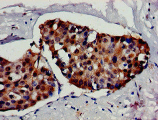 Immunohistochemistry of paraffin-embedded human breast cancer using HSF1 Antibody at dilution of 1:100Rabbit anti-Human HSF1 Polyclonal Antibody