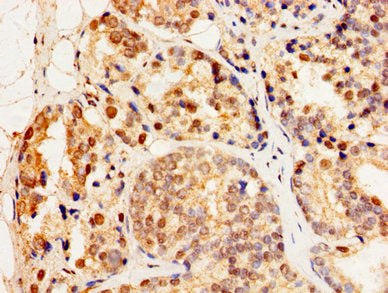 Immunohistochemistry of paraffin-embedded human prostate cancer using the antibody at dilution of 1:100Rabbit anti-Human HSF2 Polyclonal Antibody