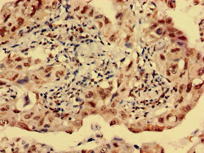 Immunohistochemistry analysis of human lung cancer using HTR1E Antibody at dilution of 1:100Rabbit anti-Human HTR1E Polyclonal Antibody