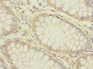 Immunohistochemistry of paraffin-embedded human colon cancer using HTR3B Antibody at dilution of 1:100Rabbit anti-Human HTR3B Polyclonal Antibody