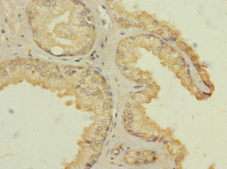 Immunohistochemistry of paraffin-embedded human prostate cancer using HTR3B Antibody at dilution of 1:100Rabbit anti-Human HTR3B Polyclonal Antibody