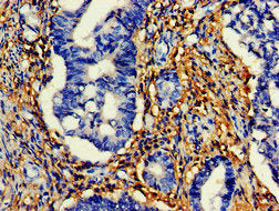 IHC image of HTRA2 Antibody diluted at 1:200 and staining in paraffin-embedded human colon cancer performed on a Leica BondTM system. After dewaxing and hydration, antigen retrieval was mediated by high pressure in a citrate buffer (pH 6.0). Section was blocked with 10% normal goat serum 30min at RT. Then primary antibody (1% BSA) was incubated at 4°C overnight. The primary is detected by a biotinylated secondary antibody and visualized using an HRP conjugated SP system.Rabbit anti-Human HTRA2 Polyclonal Antibody