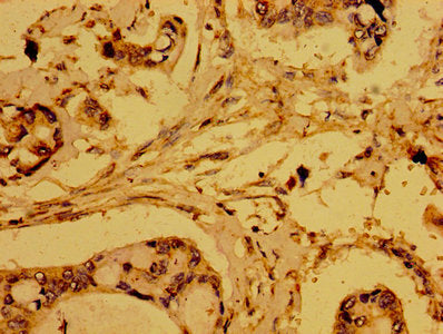 Immunohistochemistry of paraffin-embedded human pancreatic cancer using HTRA2 Antibody at dilution of 1:100Rabbit anti-Human HTRA2 Polyclonal Antibody