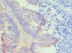 Immunohistochemistry of paraffin-embedded human ovarian cancer using HTRA2 Antibody at dilution of 1:100Rabbit anti-Human HTRA2 Polyclonal Antibody
