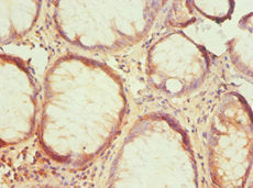 Immunohistochemistry of paraffin-embedded human colon cancer using HTRA2 Antibody at dilution of 1:100Rabbit anti-Human HTRA2 Polyclonal Antibody